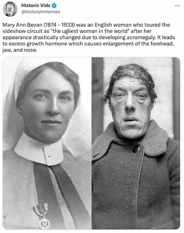 Mary Ann Bevan (1874 - 1933) was an English woman who toured the sideshow circuit as "the ugliest woman in the world" after her appearance drastically changed due to developing acromegaly. It leads to excess growth hormone which causes enlargement of the forehead, jaw, and nose.
